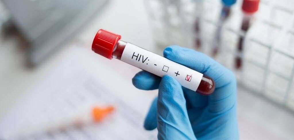 prueba-vih-positivo Tubo de ensayo con etiqueta HIV positivo en laboratorio